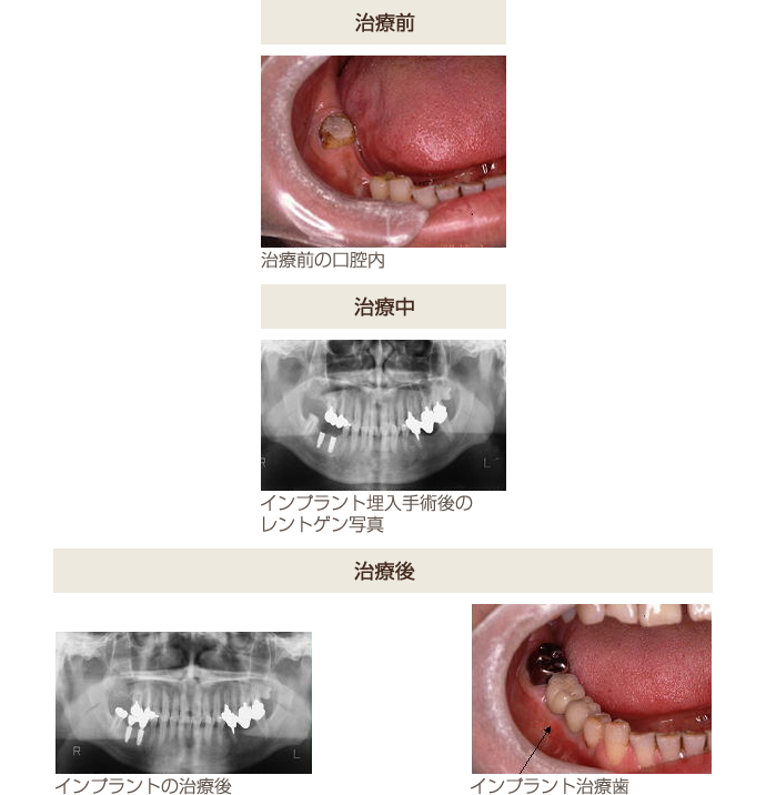 下顎臼歯部