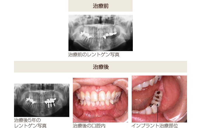 下顎奥歯・３歯