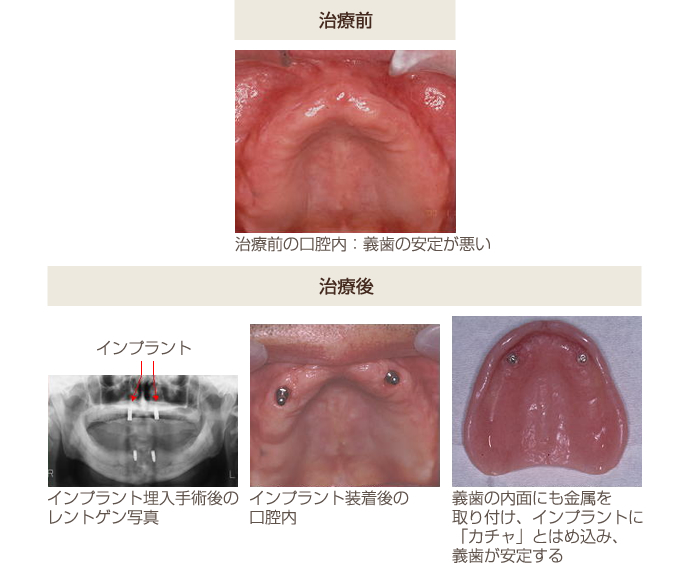 無歯顎