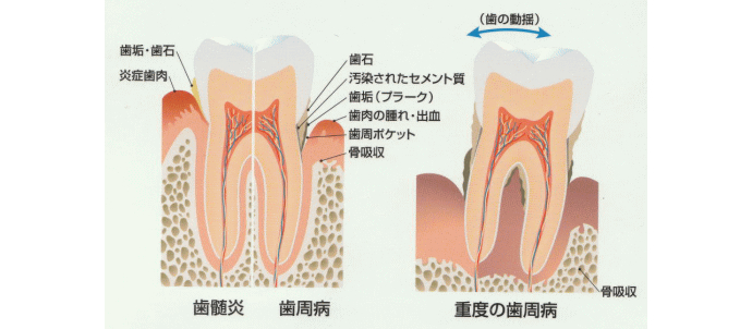 歯肉の炎症と歯周病