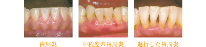 歯周炎・中程度の歯周炎・進行した歯周炎
