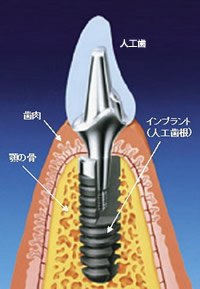 インプラント