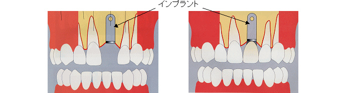 インプラント