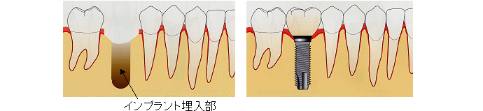 インプラント