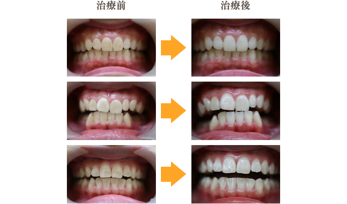 ホワイトニングの治療例