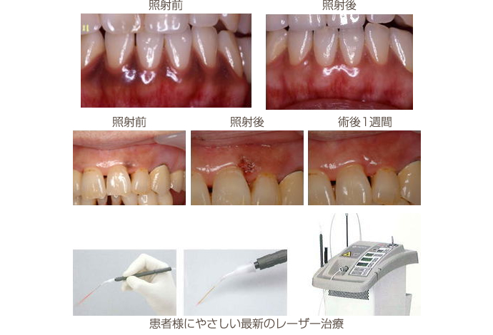 レーザー治療によりメラニン色素が除去された症例